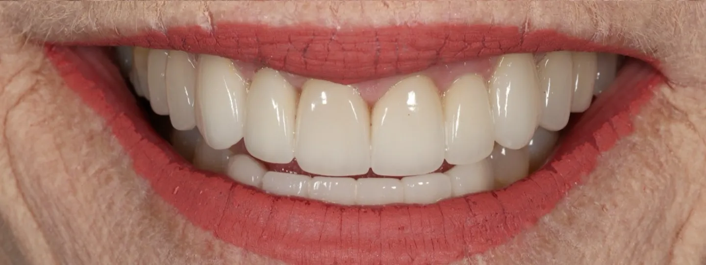 Before and after cosmetic teeth enhancement using biological dentistry techniques in Florida.