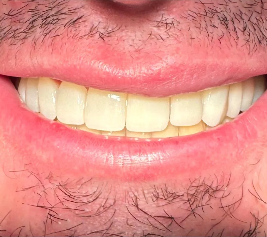Before and after teeth restoration by a biological dentist in Florida using holistic dental techniques.