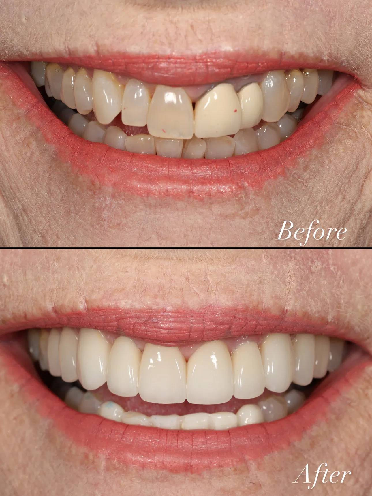 Conservative Porcelain Veneers
