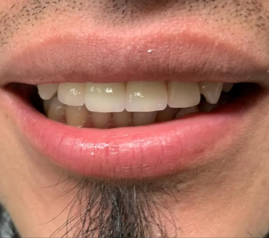Smile makeover using holistic biological dentistry techniques in Florida showing restored and healthy teeth.