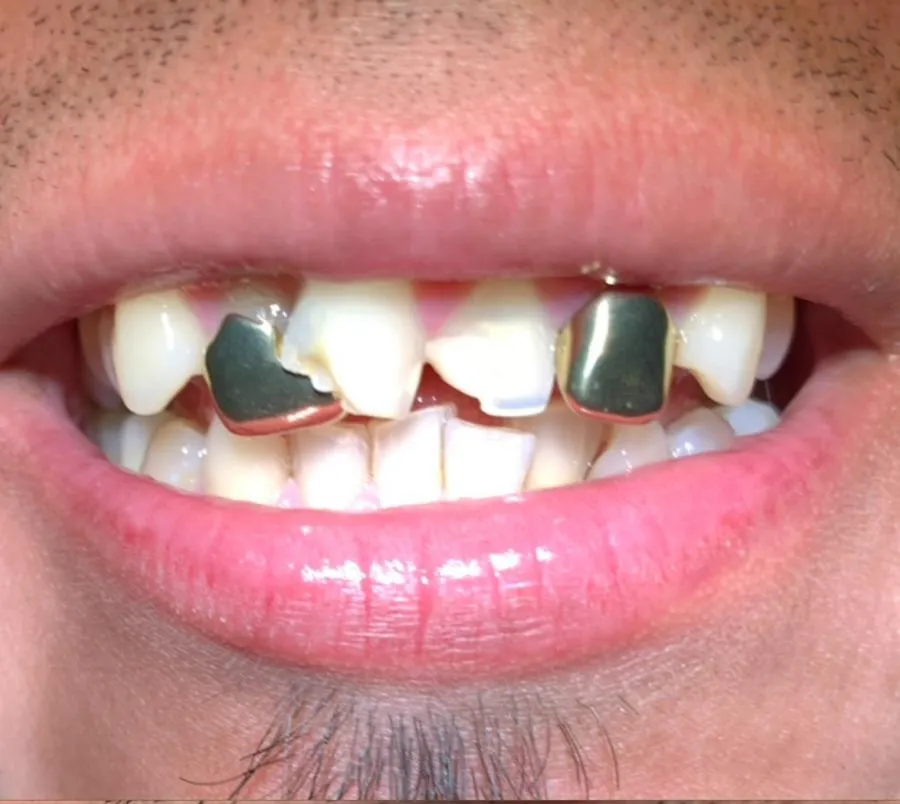 Smile makeover using holistic biological dentistry techniques in Florida showing restored and healthy teeth.